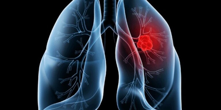 saiba-o-que-e-adenocarcinoma-pulmonar,-cancer-que-atinge-o-papa